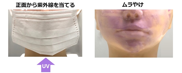 ムラやけ