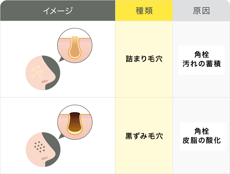 クエン酸がおすすめの毛穴の種類