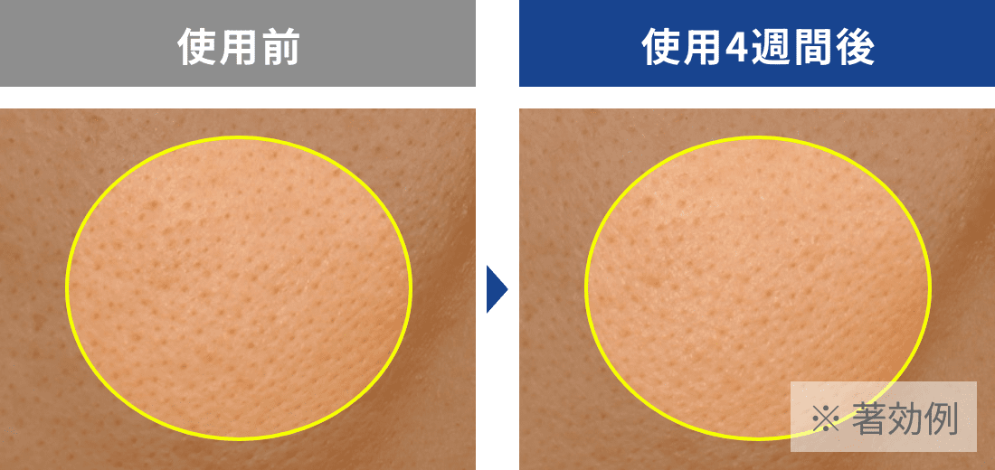 毛穴